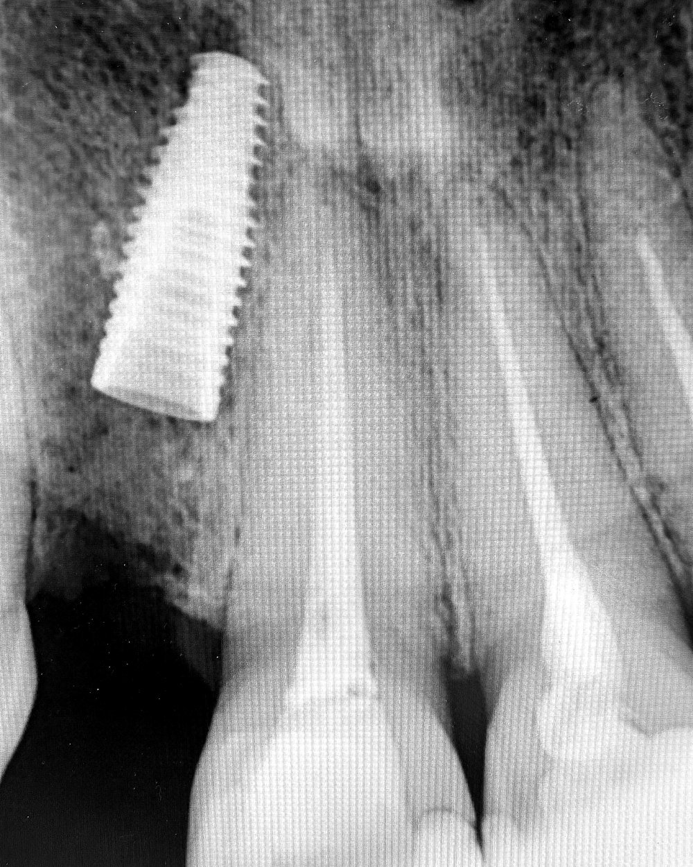 Radiografia mostrando implante dentário instalado