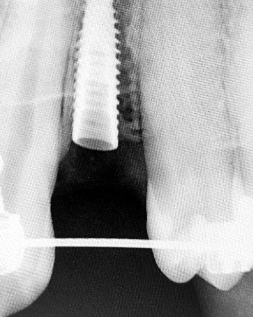 Radiografia de implante em posição, vista aproximada