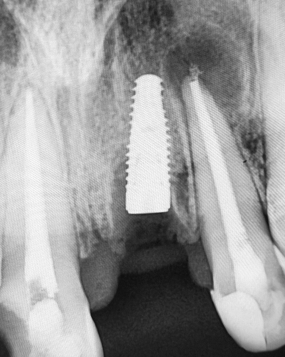 Radiografia de implante integrado ao osso